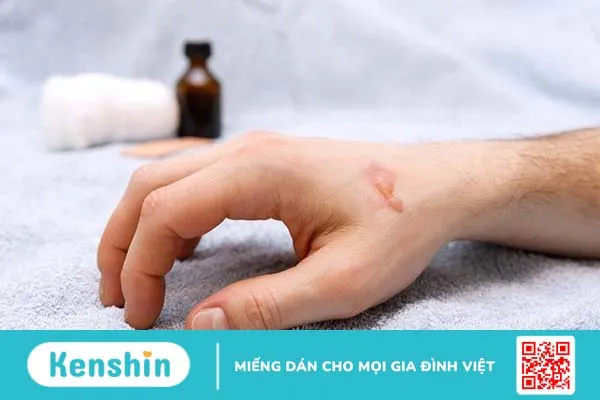 Kem đánh răng có tính kiềm giúp làm dịu các vết bỏng do axit