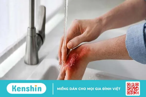 Bị chó nhà cắn có sao không? Cách xử lý như thế nào? 5