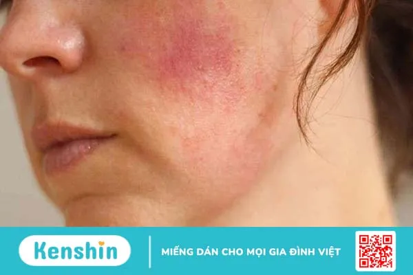 Bị dị ứng mỹ phẩm kiêng ăn gì? 1