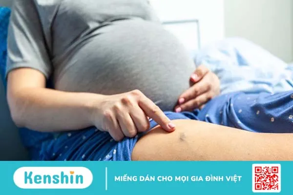 Bị giãn tĩnh mạch khi mang thai có nguy hiểm không 1