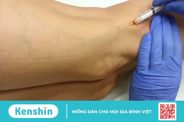 Bị giãn tĩnh mạch khi mang thai có sinh thường được không 3