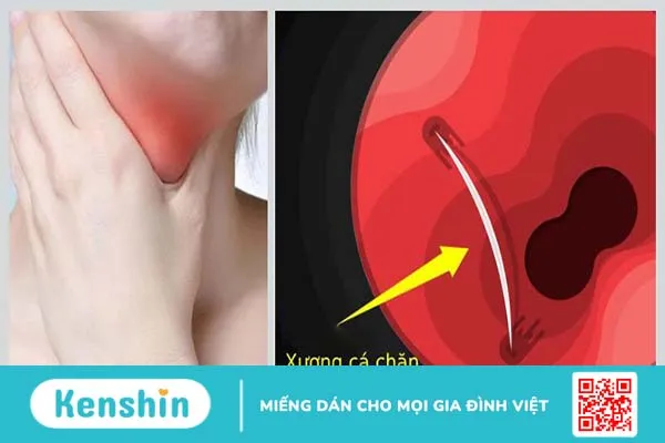 Bị hóc xương cá lâu ngày có đáng ngại không? 4