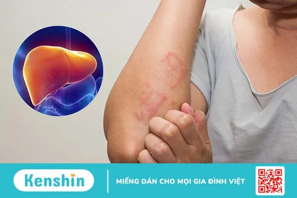 Bí kíp ngăn ngừa nóng gan, bảo vệ gan hiệu quả 1