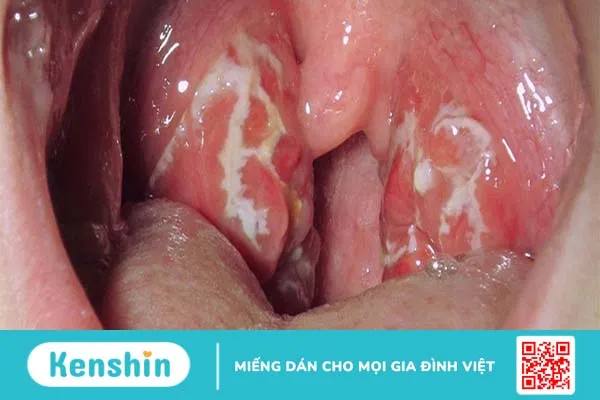 Tư vấn: Bị nấm họng kiêng ăn gì cho nhanh khỏi 1