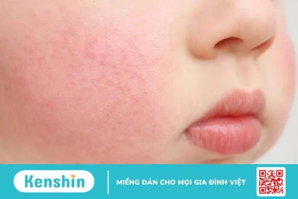 Bị nhiễm Parvovirus B19 trong thời kỳ mang thai có sao không? 1