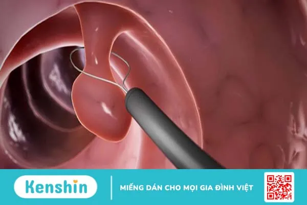 Bị polyp cổ tử cung có quan hệ được không? Làm sao để chữa trị? 4