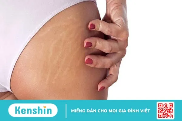 bị rạn da mông màu trắng 2