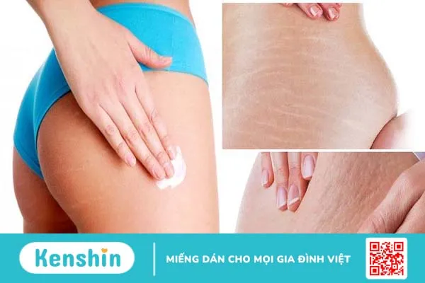 bị rạn da mông màu trắng 3