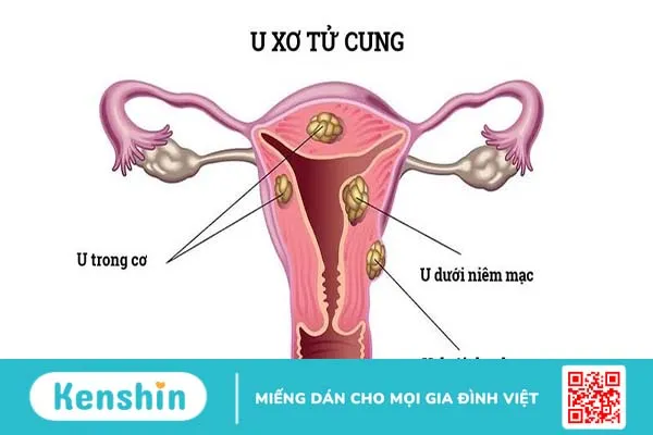 Bị rối loạn kinh nguyệt ở tuổi 20 có đáng lo ngại không? 2