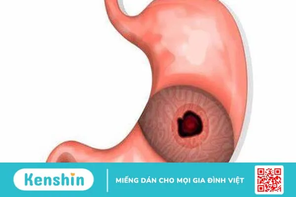 Bị thủng dạ dày có nguy hiểm không và cách điều trị như thế nào? 1