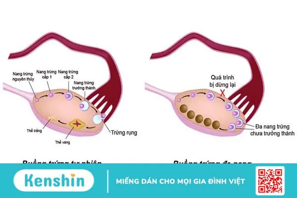 Liệu u nang buồng trứng có quan hệ được không? 1