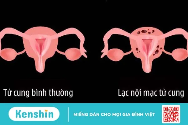 Liệu u nang buồng trứng có quan hệ được không? 2