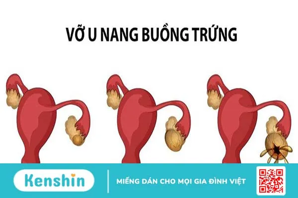 Biến chứng u nang buồng trứng bị vỡ có nguy hiểm không? 1