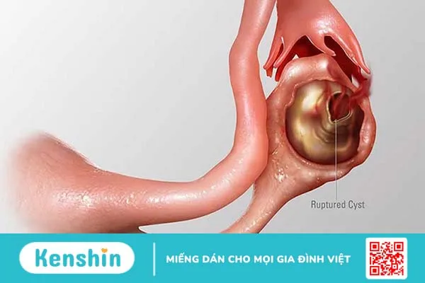 Biến chứng u nang buồng trứng bị vỡ có nguy hiểm không? 3