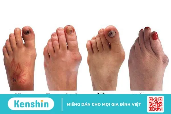 Biến dạng ngón chân cái là do đâu? Cách xử lý như thế nào? 1