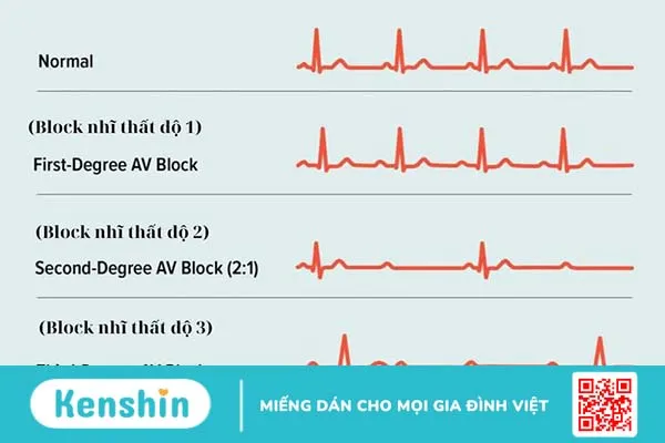 Block nhĩ thất độ 2 có nguy hiểm không 1