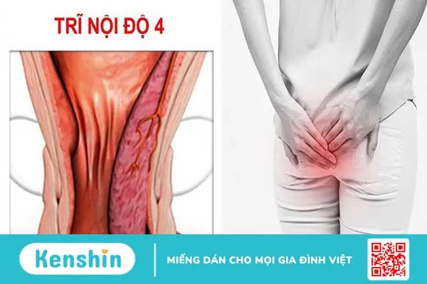 Bỏ túi các dấu hiệu của bệnh trĩ cấp độ 4 để đề phòng 1