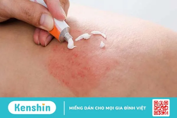 Bọ xít hút máu người có nguy hiểm không? 2