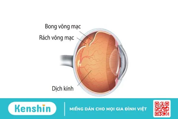 Bong dịch kính có nguy hiểm không 1