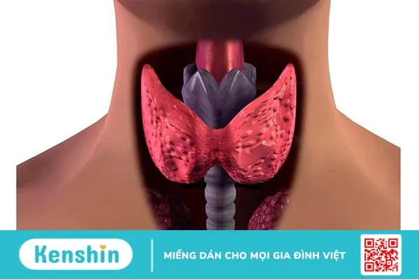 Bướu cổ đa nhân lành tính Nguyên nhân, triệu chứng và cách phòng ngừa 1