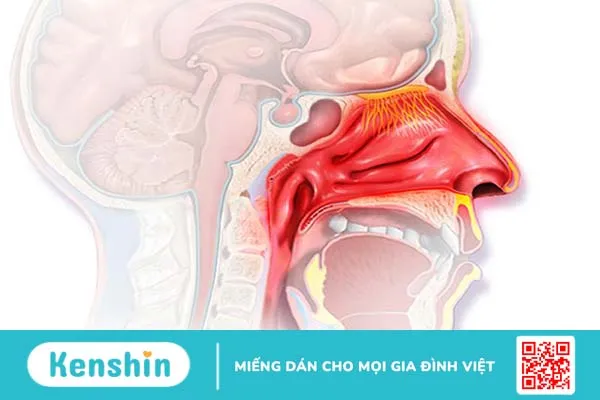 Các bệnh lý nào thường xảy ra ở đường hô hấp trên? 3