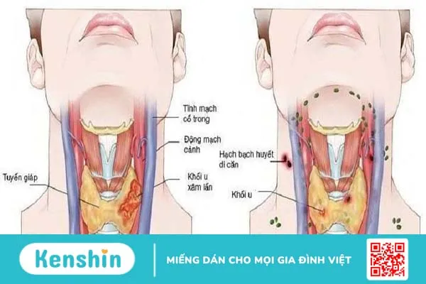 Các bệnh về họng thường gặp và cách điều trị  1