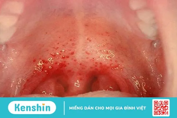 Các bệnh về họng thường gặp và cách điều trị  4