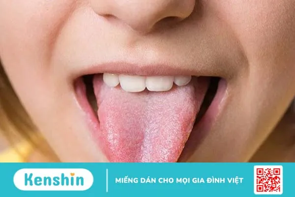 Các bệnh về lưỡi thường gặp: Nguyên nhân, triệu chứng và hướng điều trị 1