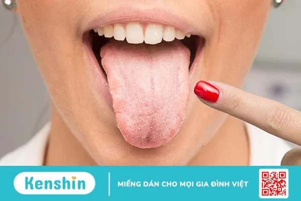 Các bệnh về lưỡi thường gặp: Nguyên nhân, triệu chứng và hướng điều trị 3