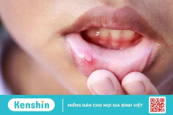 Các bệnh về lưỡi thường gặp: Nguyên nhân, triệu chứng và hướng điều trị 4