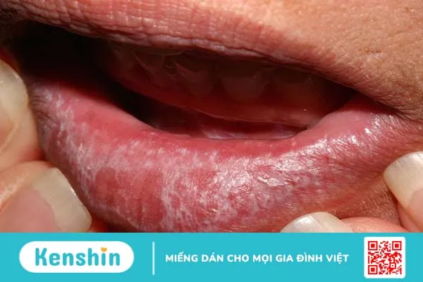 Các bệnh về lưỡi thường gặp: Nguyên nhân, triệu chứng và hướng điều trị 5