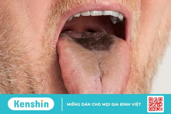 Các bệnh về lưỡi thường gặp: Nguyên nhân, triệu chứng và hướng điều trị 6