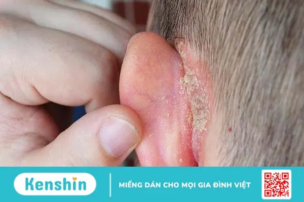 Các bệnh về tai thường gặp nhất hiện nay2