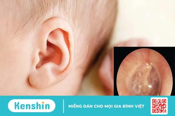 Triệu chứng, hậu quả và các cách chữa viêm tai giữa cho bé tại nhà 1