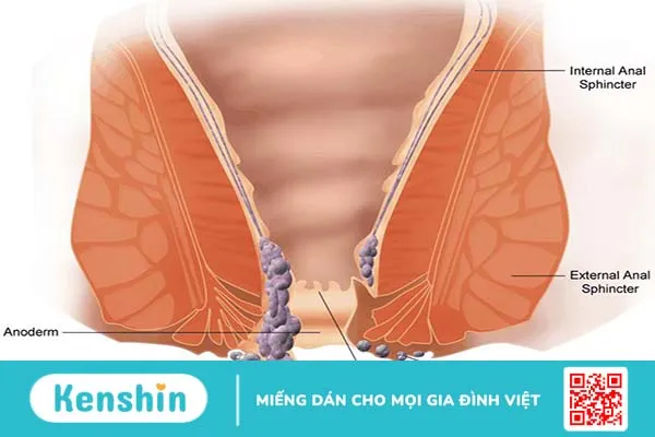 Các cấp độ của bệnh trĩ và cách nhận biết chính xác 3