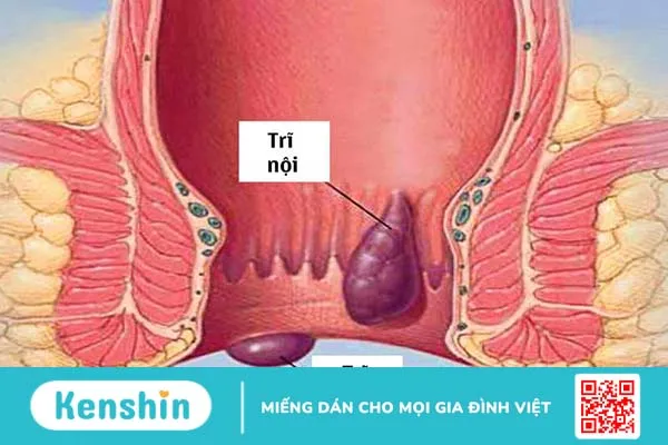 Điều trị các dấu hiệu bệnh trĩ ở nữ giới khi bệnh gây ảnh hưởng đến sinh hoạt, sức khỏe người bệnh