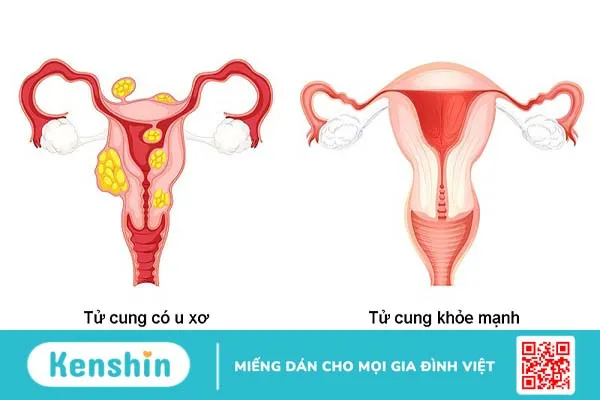 Các dấu hiệu u xơ cổ tử cung thường gặp nhất 1