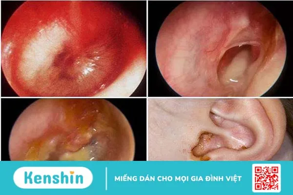 Các dấu hiệu và cách vệ sinh tai khi bị thủng màng nhĩ ở trẻ 2