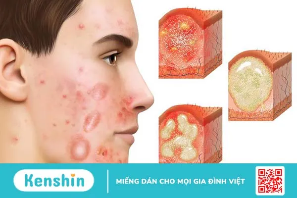 Các loại mụn viêm dưới da và cách điều trị 1