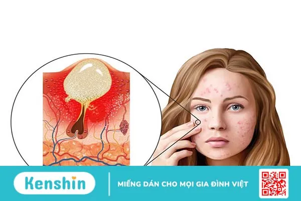 Các loại mụn viêm dưới da và cách điều trị 2