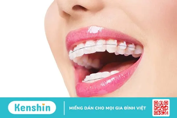 Các loại răng vẩu thường gặp và cách khắc phục 2