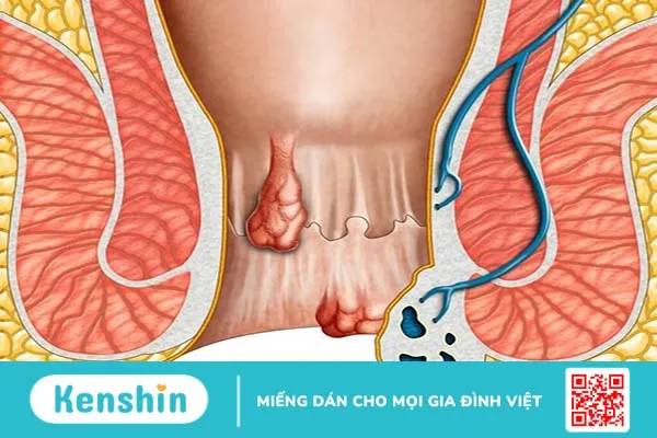 Giai đoạn phát triển của bệnh trĩ nội? Các loại thuốc trị bệnh trĩ nội được các bác sĩ khuyên dùng?