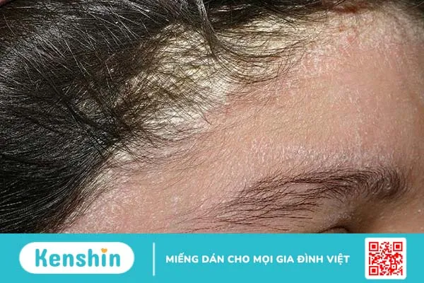 Bệnh vảy nến mức độ vừa và nặng thường được điều trị bằng các loại thuốc có tác dụng mạnh