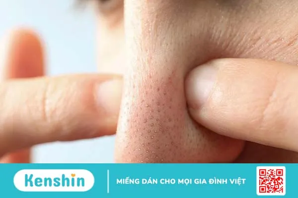 Các nguyên nhân gây mụn phổ biến và những điều cần lưu ý 3