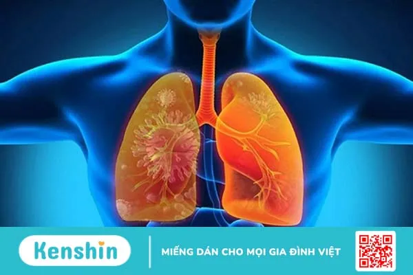 Các tiêu chuẩn chẩn đoán viêm phổi-1