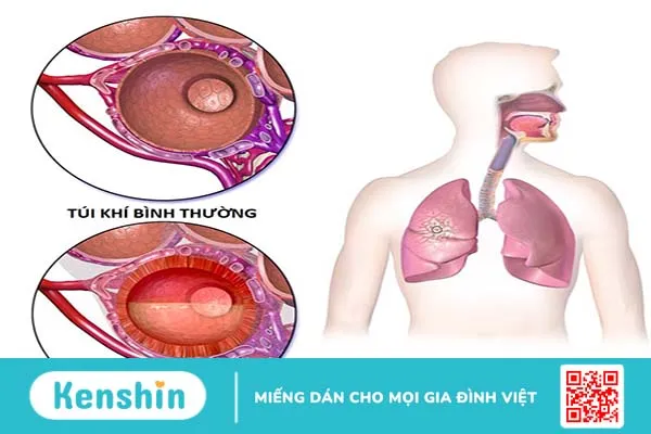 Các tiêu chuẩn chẩn đoán viêm phổi-2