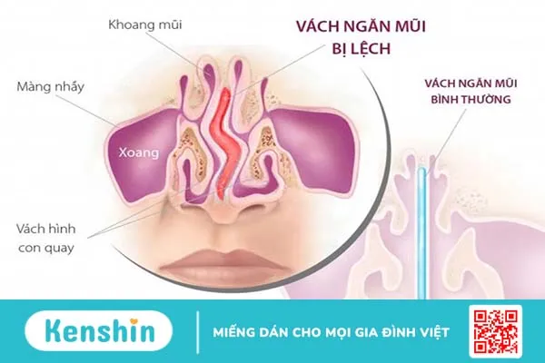 Cách bấm huyệt trị nghẹt mũi sao cho đúng và đạt hiệu quả? 1