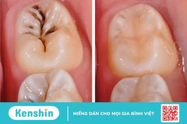 Trám răng phòng ngừa cho trẻ em