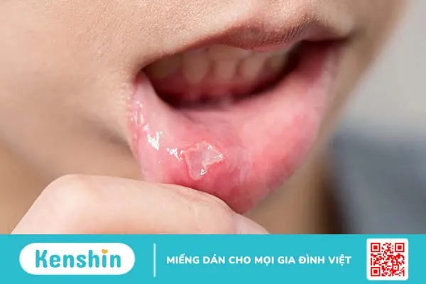 Cách chọn thuốc mỡ bôi nhiệt miệng hiệu quả nhanh chóng 1