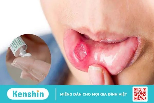 Cách chọn thuốc mỡ bôi nhiệt miệng hiệu quả nhanh chóng 4